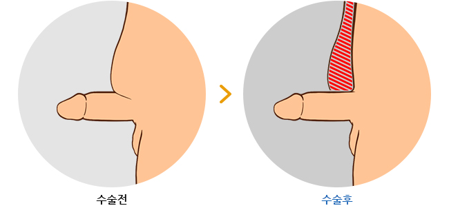 하이맨 함몰음경교정 길이연장술 수술 전 / 후