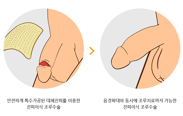 진피이식조루수술