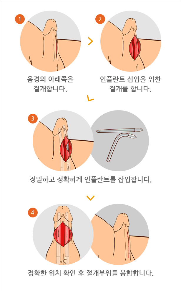 굴곡형 인플란트 삽입술