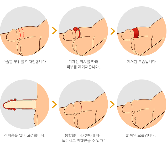 하이맨의 볼륨업 특수포경수술