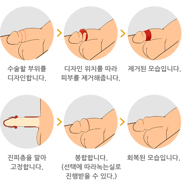 하이맨의 불륨업 특수포경수술