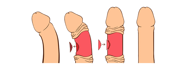 조직 이식법